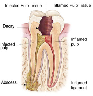 Inflamed Tooth