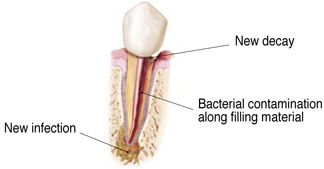 New Decay or Infection