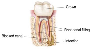 Endodontic Retreatment