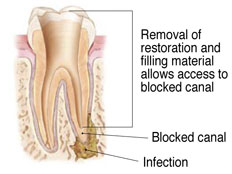 Removal of restoration and filling