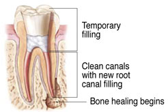 Temporary Filling