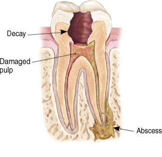 Endodontic Procedure