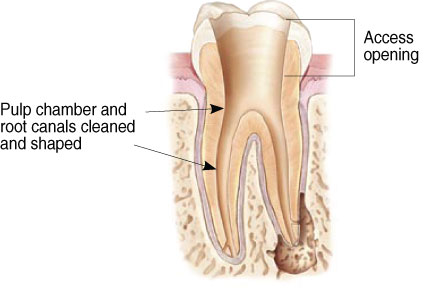 Cleaning the pulp and root canals