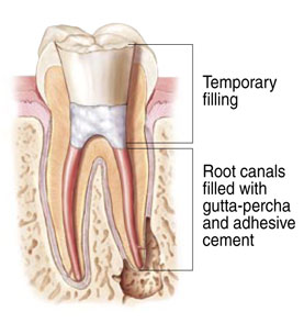 Temporary Filling