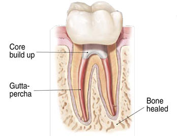 Crown or Restoration