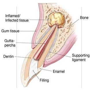 Endodontic Surgery