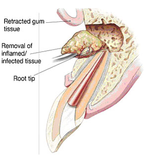 Apicoectomy