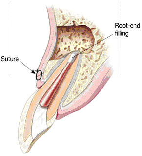 Apicoectomy