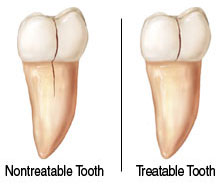 Cracked Tooth